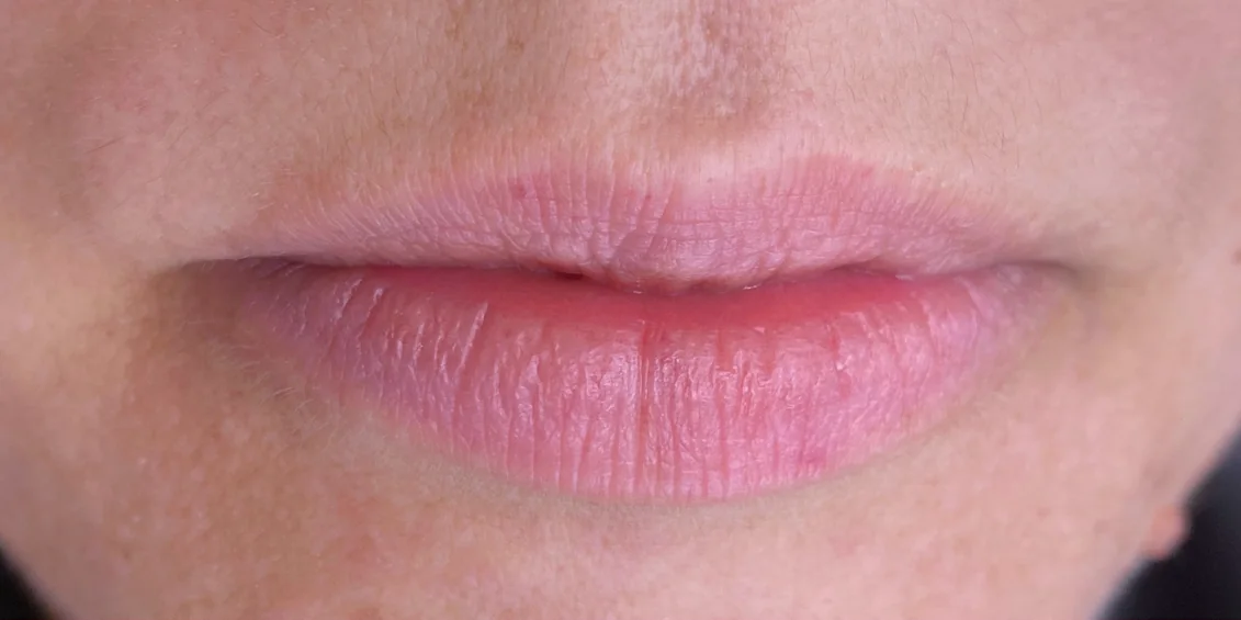 Lábios antes do procedimento Suavizze Lips